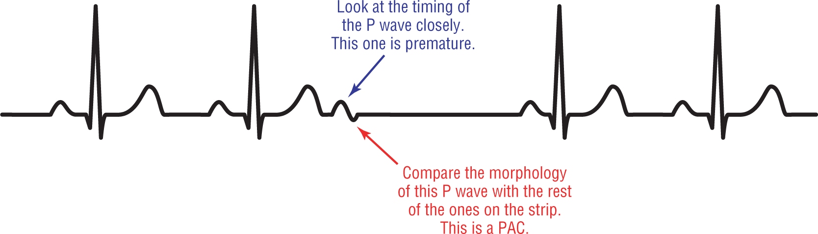 An illustration of an ECG complex shows blocked premature atrial contraction.