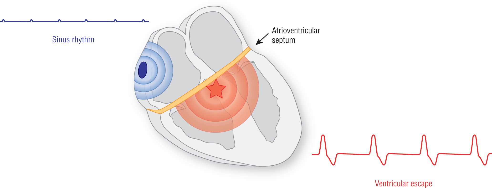 An illustration shows the pattern of waveforms when the atrioventricular septum completely separates the atria from the ventricles.