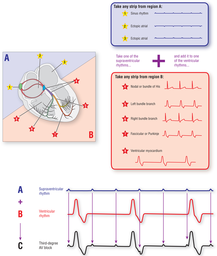 An illustration shows the combinations of supraventricular and ventricular rhythm that results in third-degree AV block.