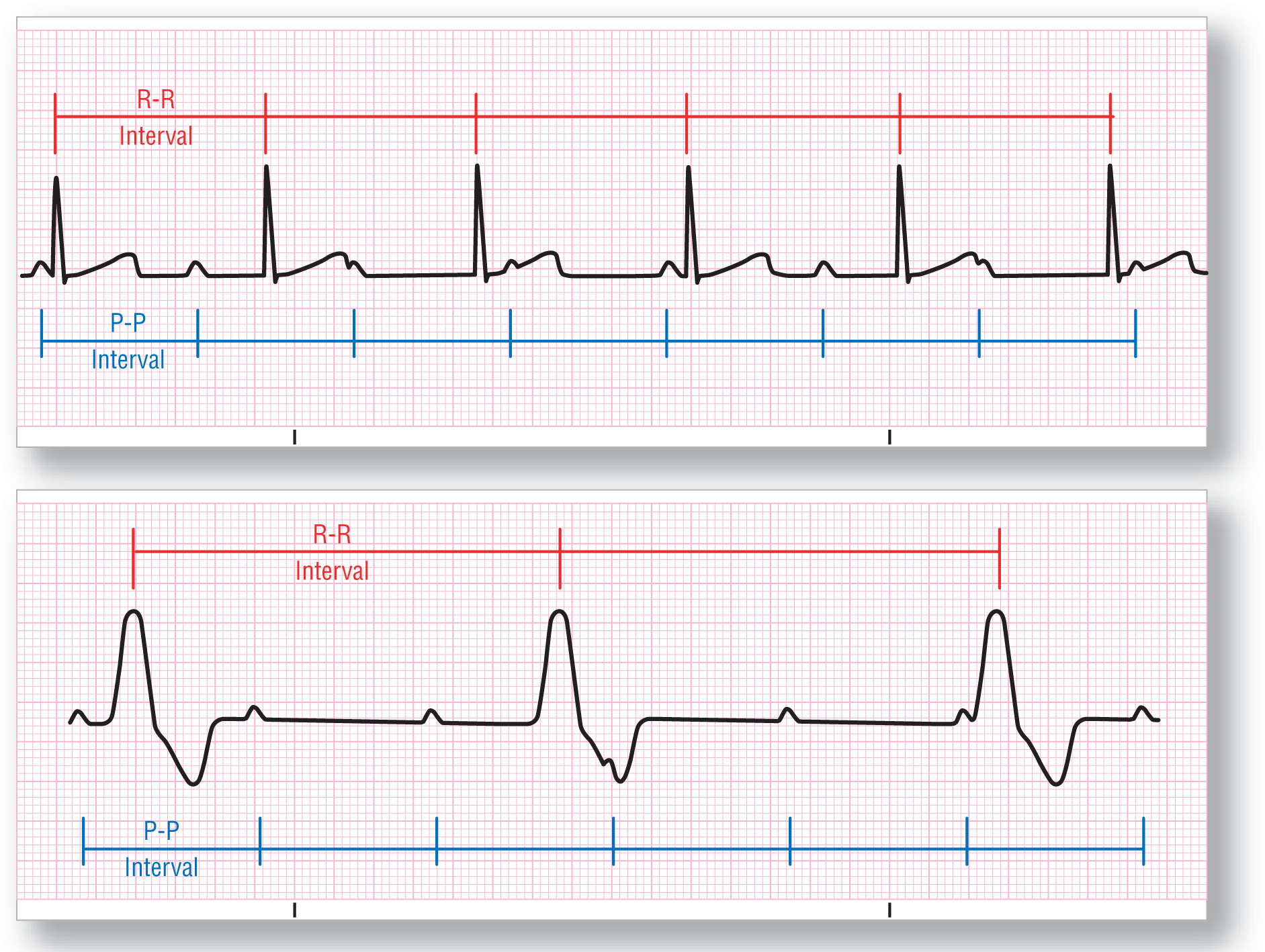 Two ECG strips show two examples of complete block. In both strips, P-P and R-R intervals are consistent. But PR intervals vary and P waves are sometimes buried in T waves or QRS complexes.