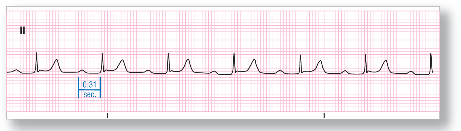 A rhythm strip from lead 2 shows a small and curved peak of the P wave, a narrow and sharp peak of the QRS complex, and a wide peak of the T wave. PR interval is 0.31 seconds.