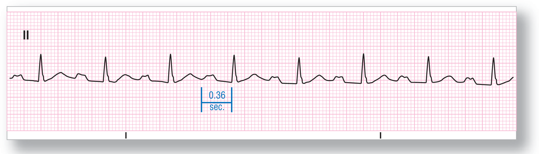 A rhythm strip from lead 2 shows a broad peak of the P wave with notching, a sharp peak of the QRS complex, and a wide and short peak of the T wave. PR interval is 0.36 seconds.