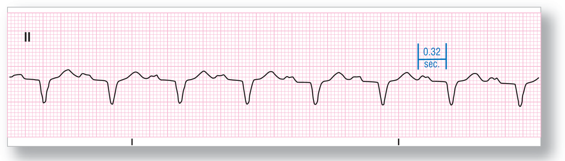 A rhythm strip from lead 2 shows a broad peak with notching of the P wave, a dip of the QRS complex, and a wide and short peak of the T wave. PR interval is 0.32 seconds.