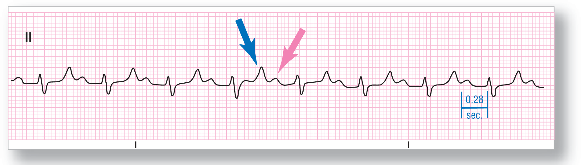 A rhythm strip from lead 2 shows a small and curved peak of the P wave, a small peak of the R wave, a small dip of the S wave, and a small peak of the T wave. PR interval is 0.28 seconds.