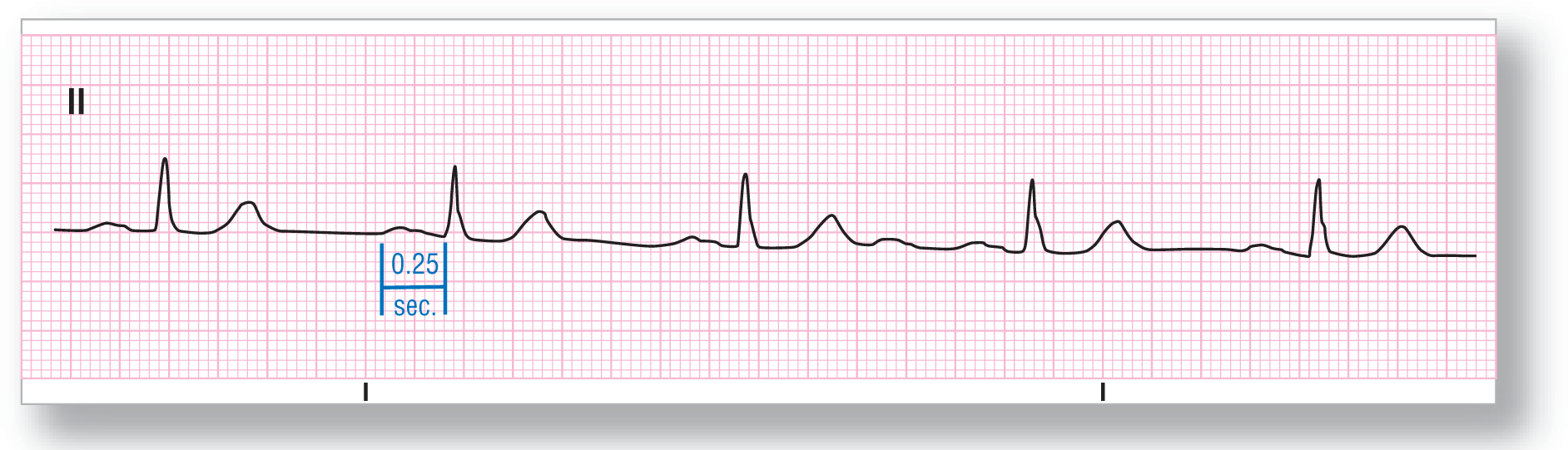 A rhythm strip from lead 2 shows a wide and an indiscernible peak of the P wave, a sharp peak of the QRS complex, and a curved peak of the T wave. PR interval is 0.25 seconds.