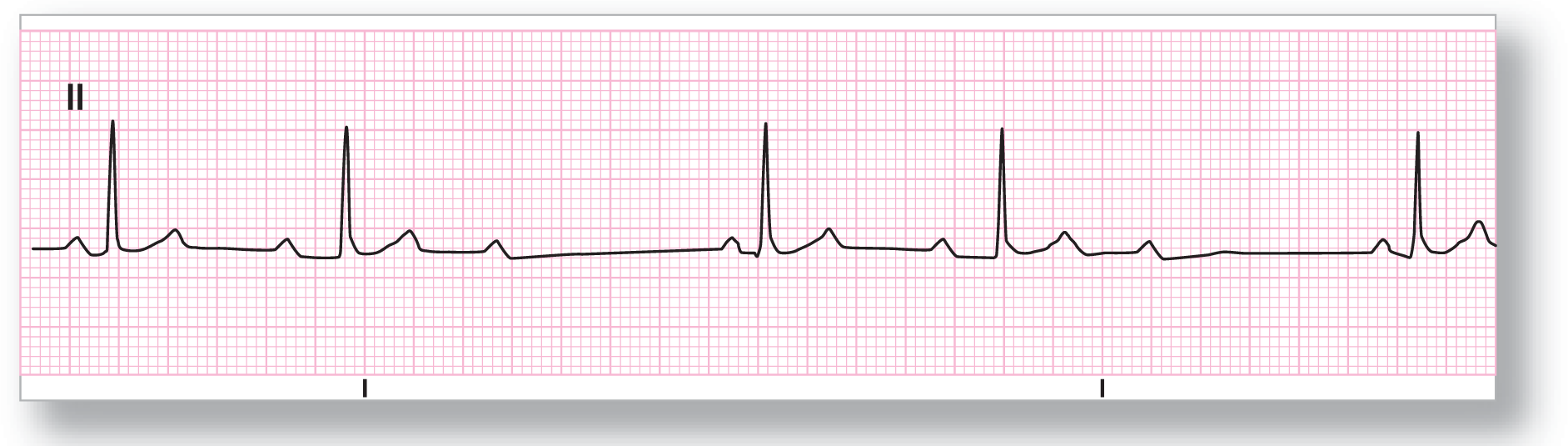 A rhythm strip from lead 2 shows a small and curved peak of the P wave, a tall and narrow peak of the QRS complex, and a small peak of the T wave. Every third wave is dropped.