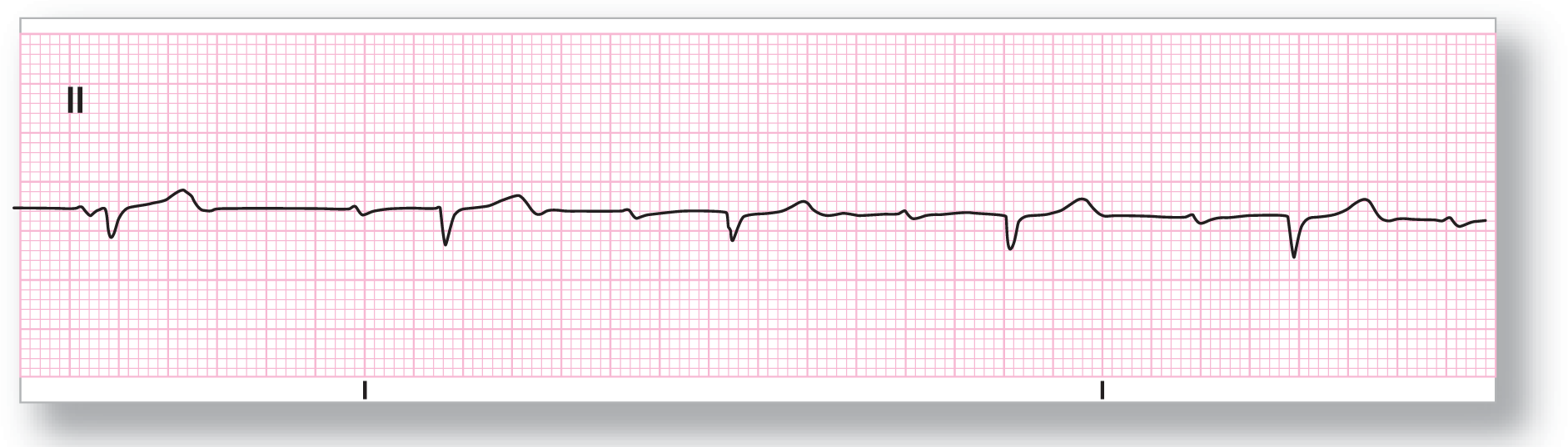 A rhythm strip from lead 2 shows a small dip of the P wave, a narrow dip of the QRS complex, and a curved peak of the T wave. The PR interval increases progressively.