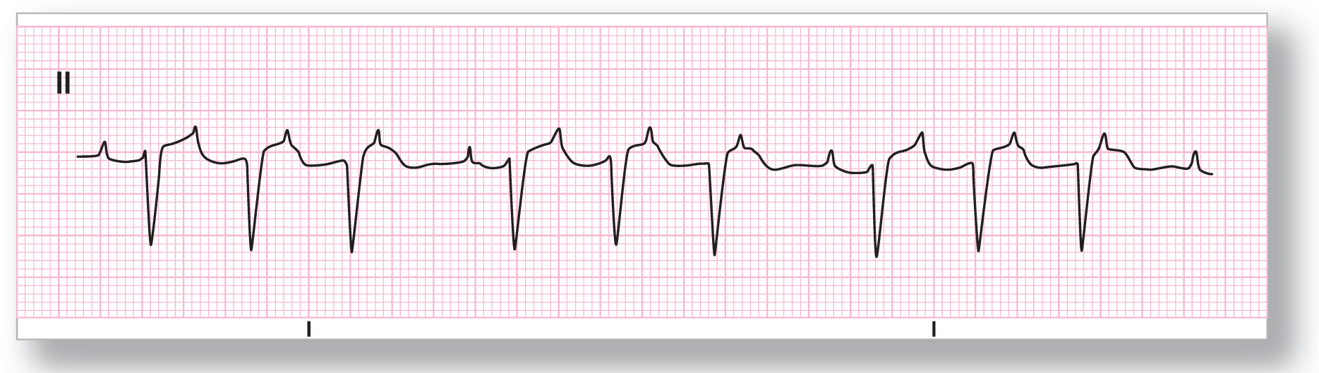 A rhythm strip from lead 2 shows a small and narrow peak of the P wave, a sharp dip of the QRS complex, and a broad peak with a sharp tip of the T wave. The PR interval increases progressively till the nonconducted P wave.