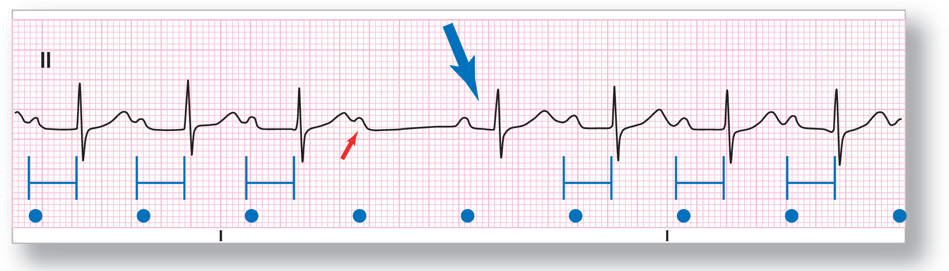 A rhythm strip from lead 2 illustrates Mobitz 2 second-degree AV block.