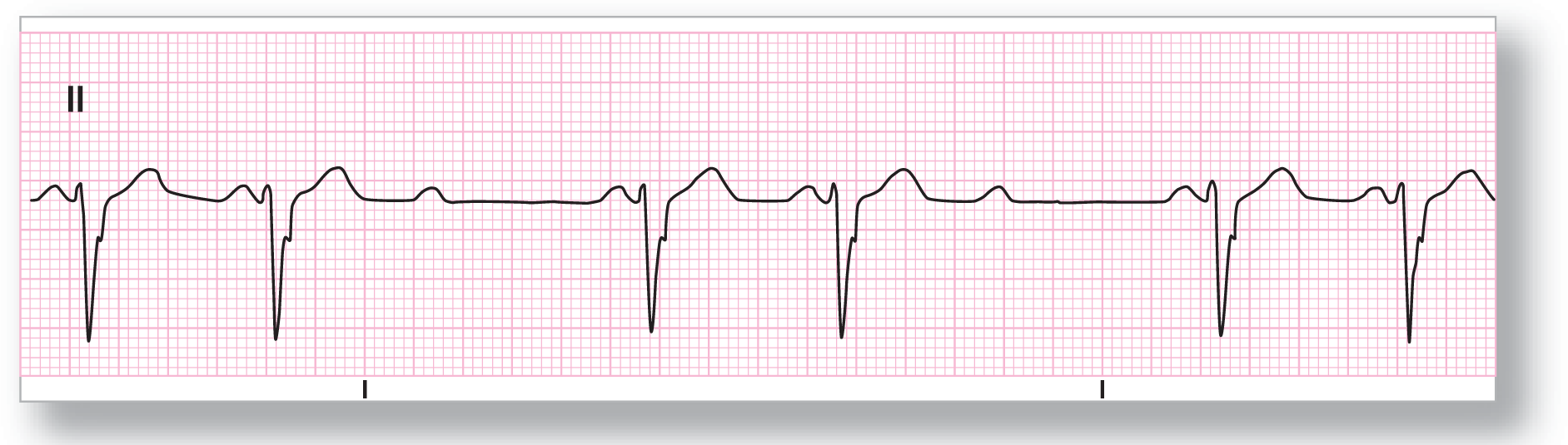 A rhythm strip from lead 2 shows a curved peak of the P wave, a sharp dip of the QRS complex with a notching in the upstroke, and a wide and curved peak of the T wave. The complex represents 3-to-2 conduction.