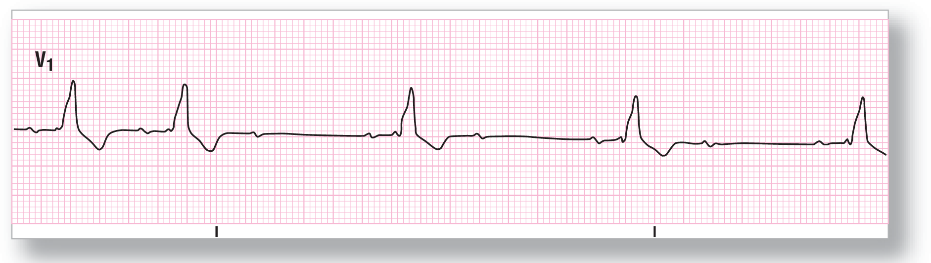 A rhythm strip from lead V1 shows an imperceptible peak and dip of the P wave, a wide peak of the QRS complex, and a wide dip of the T wave. The complex represents 3-to-2 and 2-to-1 conduction.