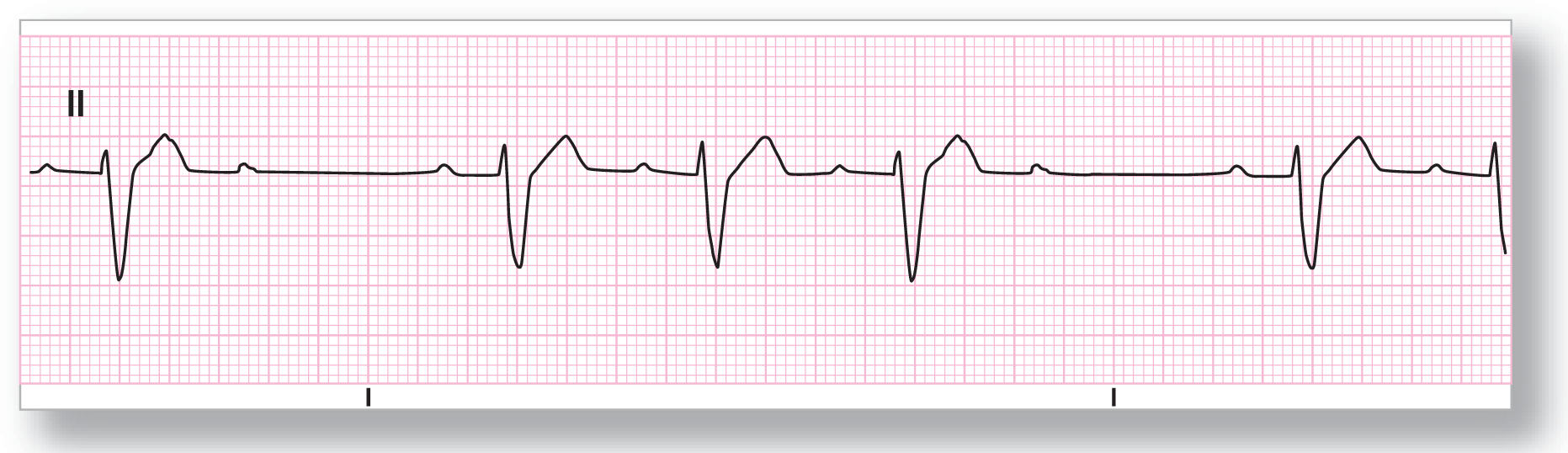 A rhythm strip from lead 2 shows an imperceptible peak of the P wave, a wide dip of the QRS complex, and a wide and curved peak of the T wave. The complex represents 4-to-3 conduction.