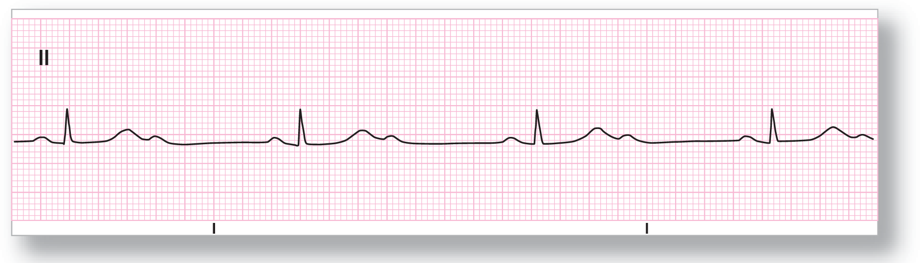 A rhythm strip from lead 2 shows a small and curved peak of the P wave, a small and narrow peak of the QRS complex, a wide and curved peak of the T wave, and another small and curved peak.