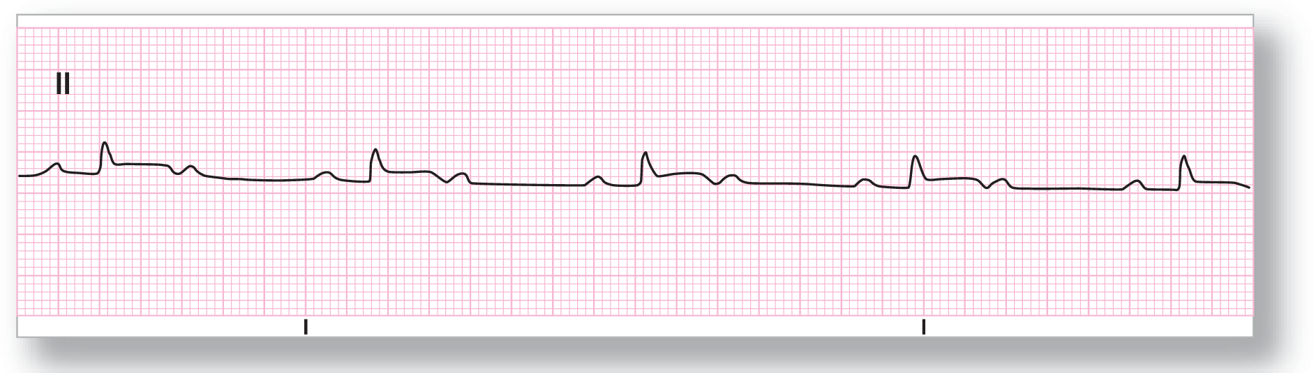 A rhythm strip from lead 2 shows a small peak of the P wave, a small and narrow peak of the QRS complex, a short period of plateau, and a small dip and peak of the T wave.