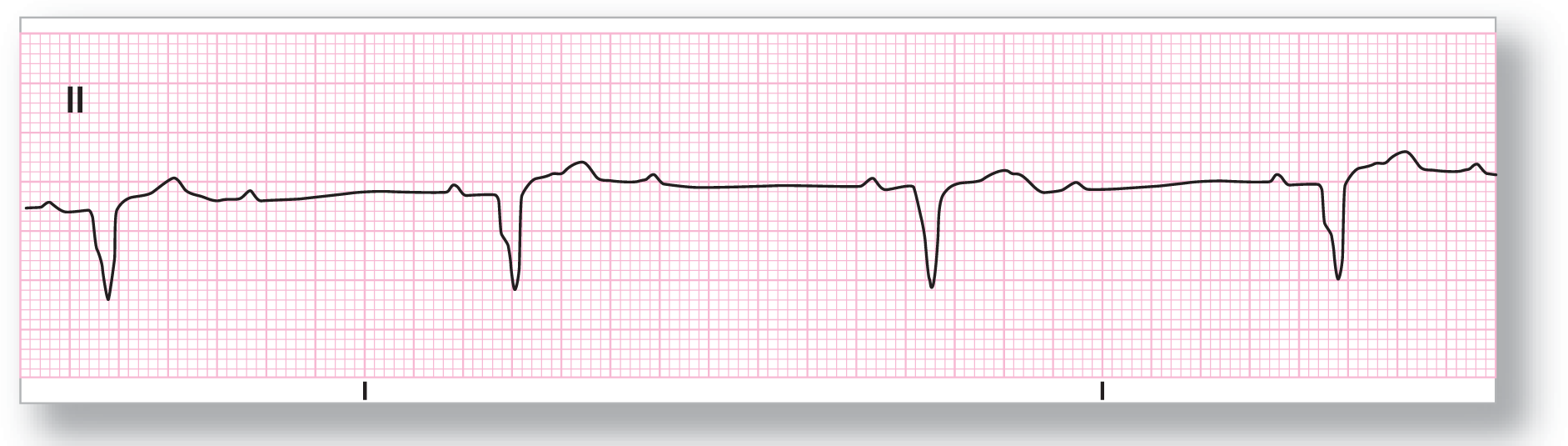 A rhythm strip from lead 2 shows a small and curved peak of the P wave, a small dip of the QRS complex, a wide and curved peak of the T wave, and another small and curved peak.