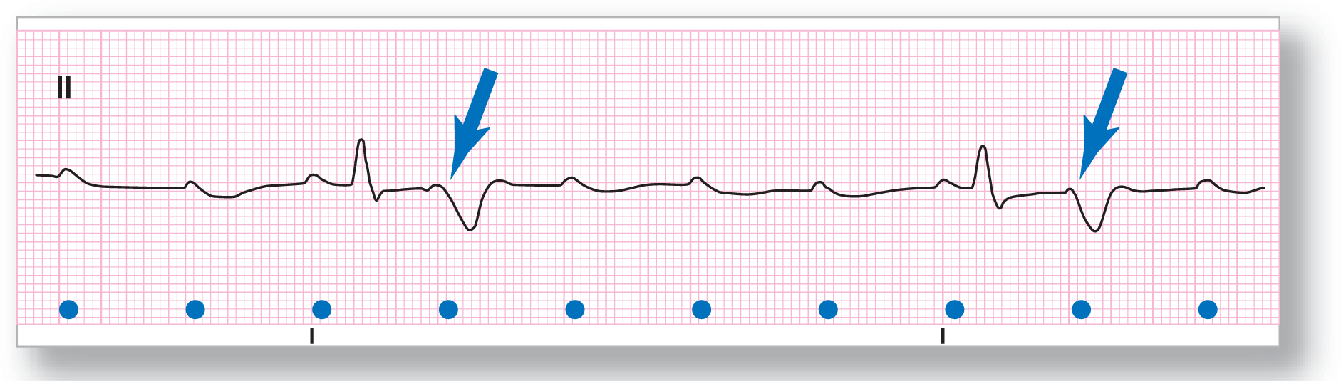 A rhythm strip from lead 2 shows a small and curved peak of the P wave, some of which are nonconducting, a peak of the QRS complex, and a wide dip of the T wave. A P wave is buried in a T wave.