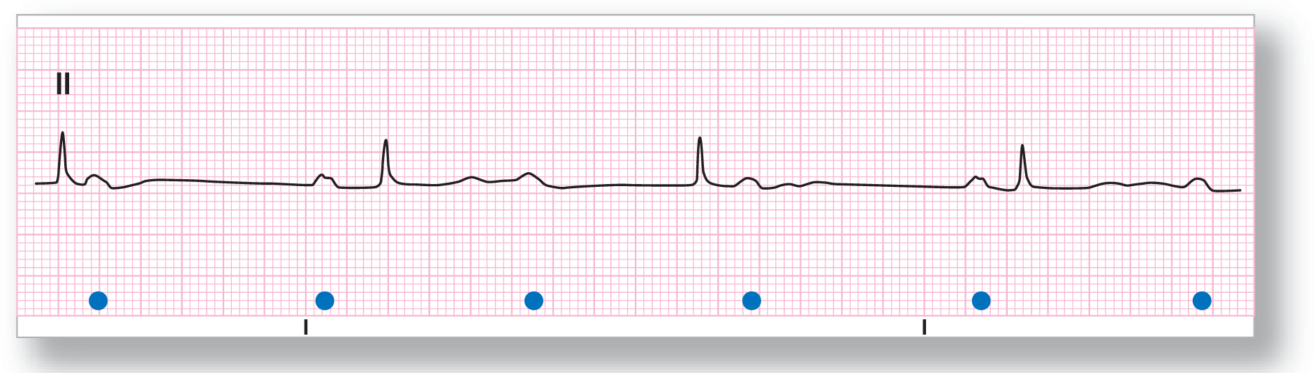 A rhythm strip from lead 2 shows a sharp and narrow peak of the QRS complex and a curved peak of the P wave. The PR intervals vary.