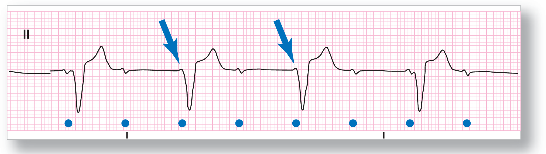 A rhythm strip from lead 2 shows an inverted P wave, a sharp dip of the QRS complex, and a broad peak of the T wave. Two P waves are buried in the second and third QRS complexes.