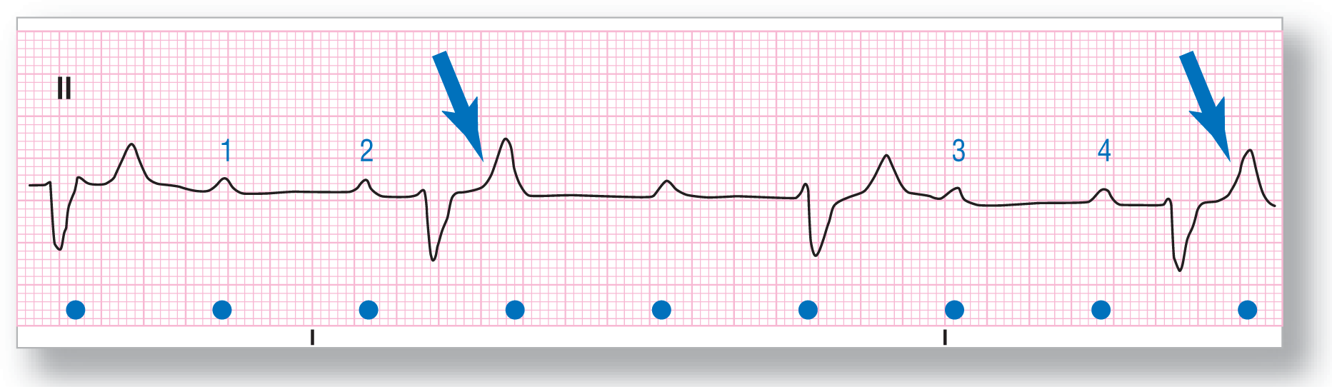 A rhythm strip from lead 2 shows a dip of the QRS complex and a curved peak of the T wave. Between two sets of two such complexes are two P waves, labeled 1 through 4. A P wave is buried in the second complex.