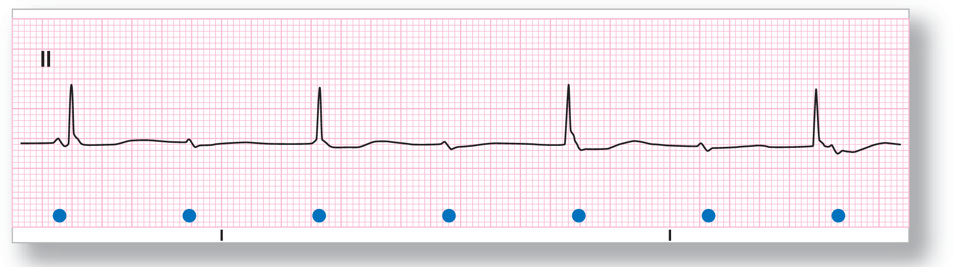 A rhythm strip from lead 2 shows a small peak of the P wave, a narrow peak of the QRS complex, and a wide and imperceptible peak of the T wave. Every other P wave is without a QRS complex.