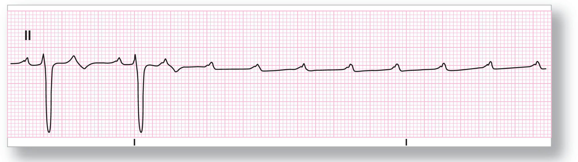 A rhythm strip from lead 2 shows a curved peak of the P wave, a dip of the QRS complex, and a wide peak of the S wave. After the second complex, the P waves are without QRS complexes.