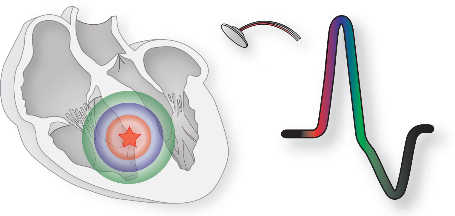 An illustration shows the structure of the waves originating from an irritable focus and the morphology of the QRS complex.