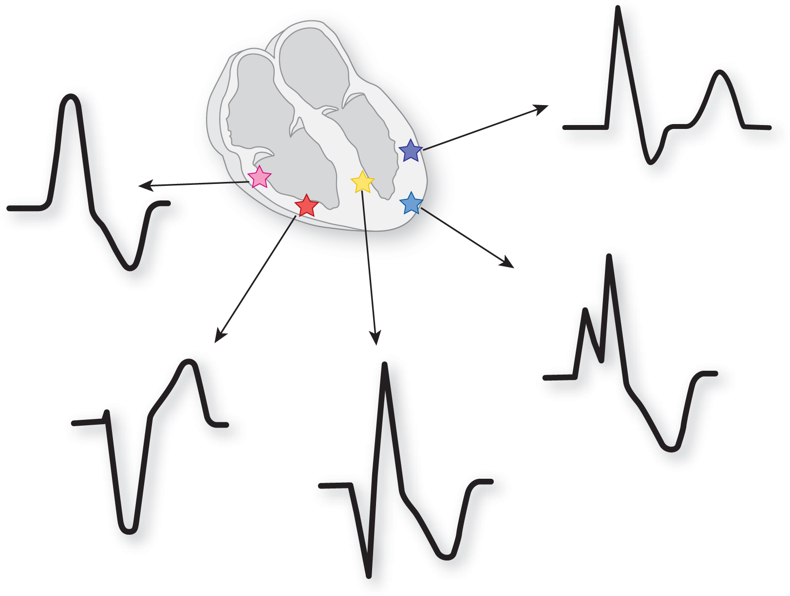 An illustration shows the morphology of QRS complexes in ventricular ectopic foci.