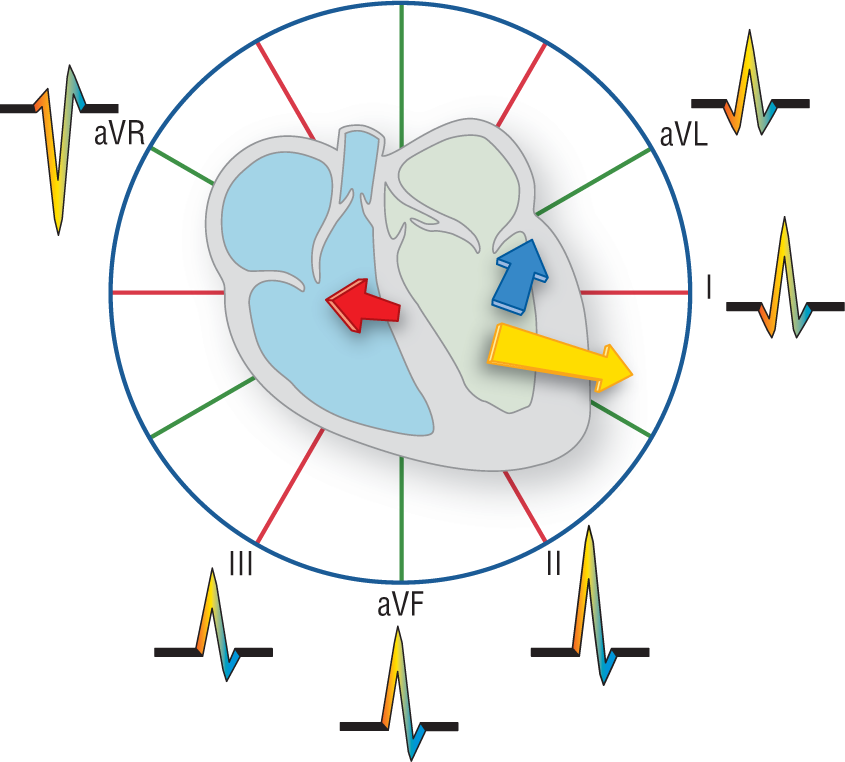 An illustration shows the morphology of QRS complexes at different leads.