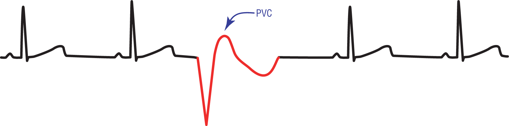 An ECG complex shows waveforms with normal patterns. The third complex, labeled PVC, consists of a wide and sharp dip, a curved peak, and a curved dip.