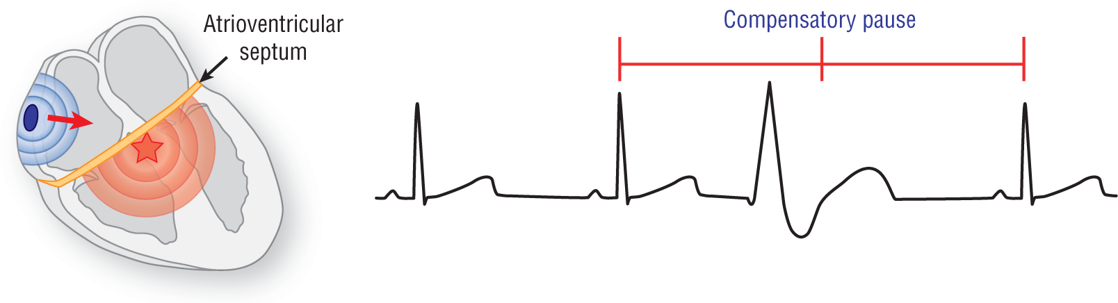 An illustration depicts compensatory pause.