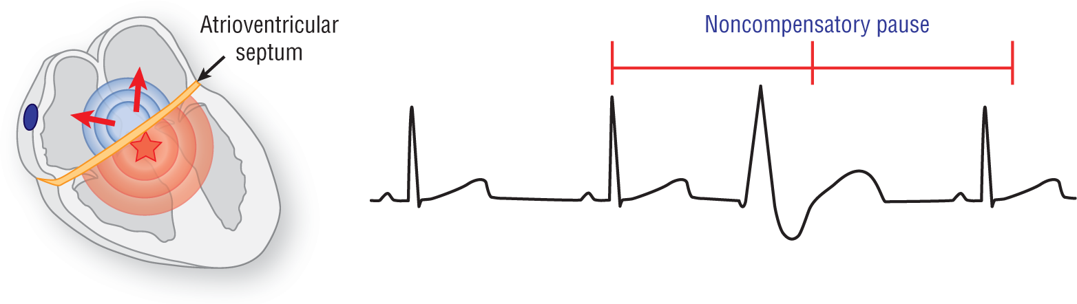 An illustration depicts noncompensatory pause.