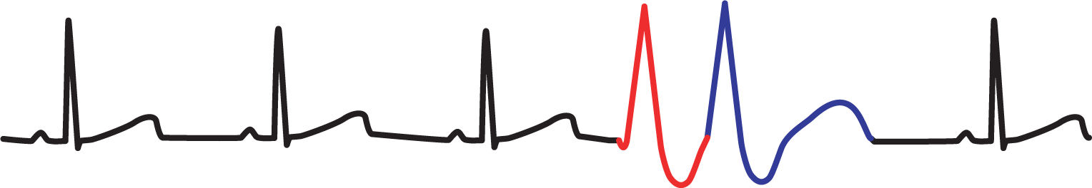 An ECG complex for unifocal couplet shows two PVCs occurring sequentially.