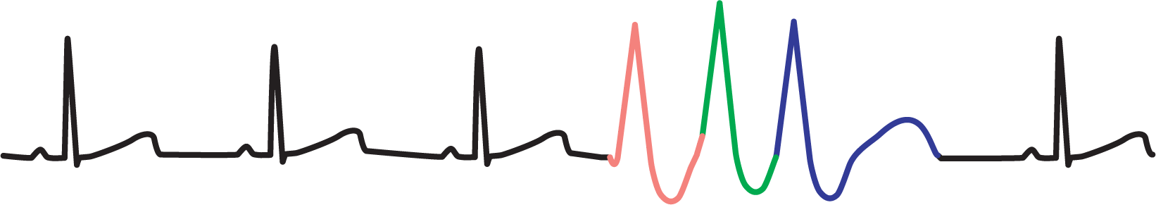 An ECG complex for unifocal triplet shows three PVCs occurring sequentially.