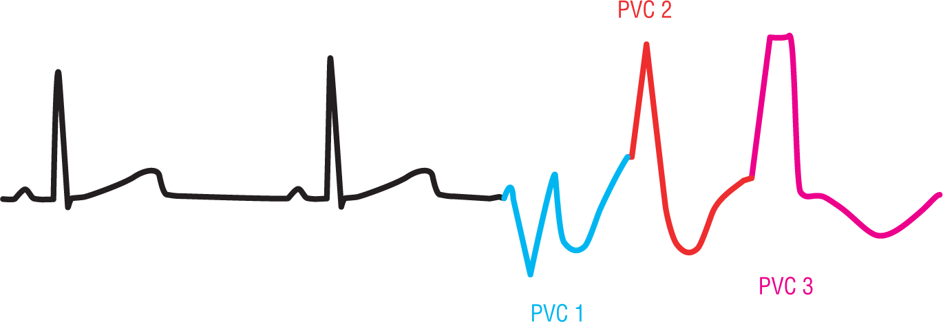 An ECG complex for multifocal triplet shows three different types of PVCs, 1 through 3, occurring sequentially.