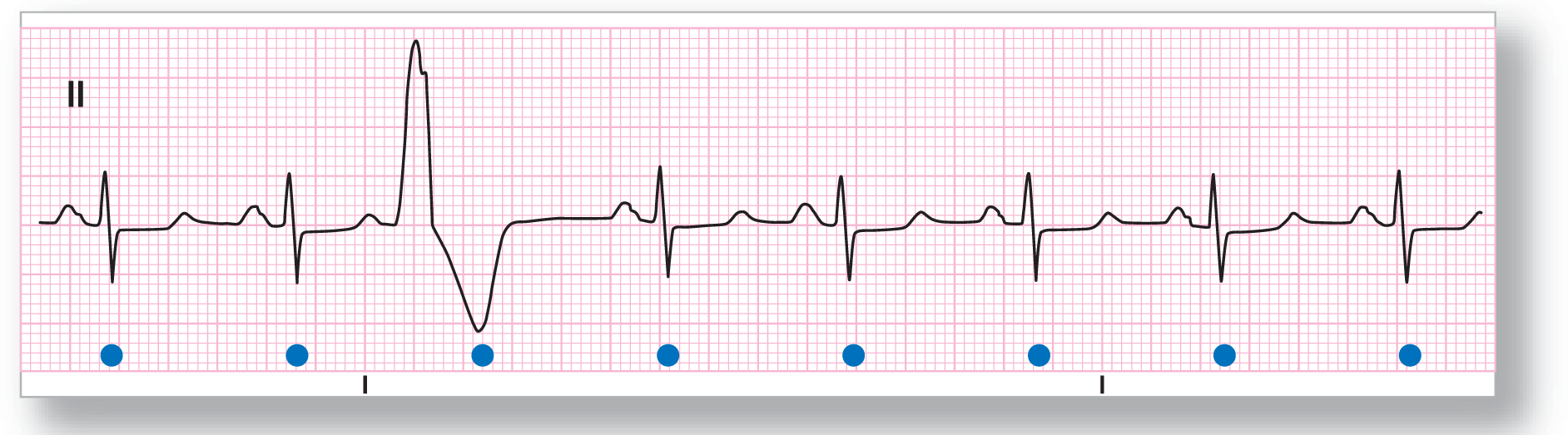 A rhythm strip from lead 2 shows a small and curved peak of the P wave, a sharp peak of the R wave, a sharp dip of the S wave, and a small and curved peak of the T wave. A PVC, with wide peak and dip, occurs at the third complex.