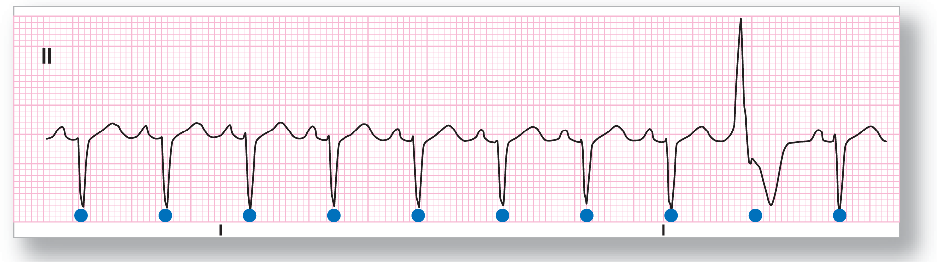 A rhythm strip from lead 2 shows a small and curved peak of the P wave, a sharp dip of the QRS complex, and a small and curved peak of the T wave. A PVC, with a sharp peak and a wide dip with notching in the downstroke, occurs in the complex.