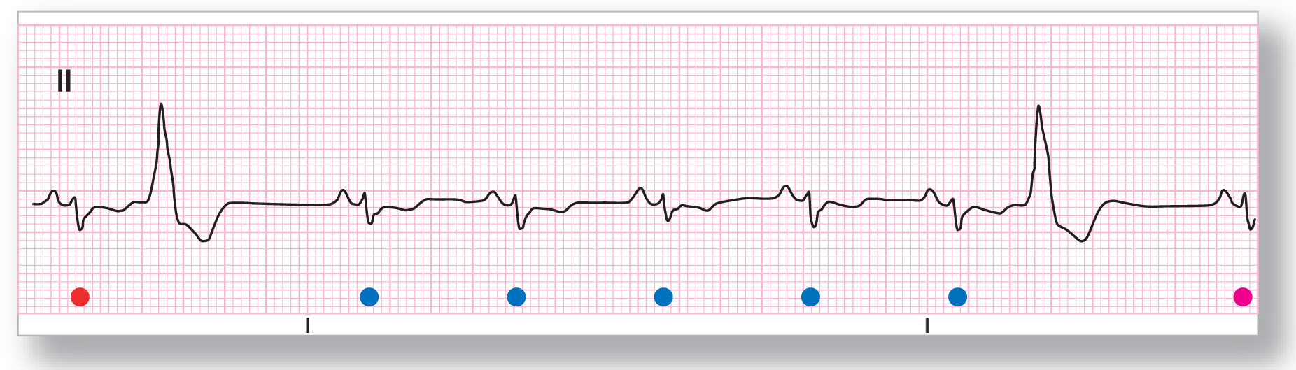 A rhythm strip from lead 2 shows a small and curved peak of the P wave, a small and sharp peak of the R wave, a small dip of the S wave, and wide dip of the T wave. PVCs occur as wide peak and dip.