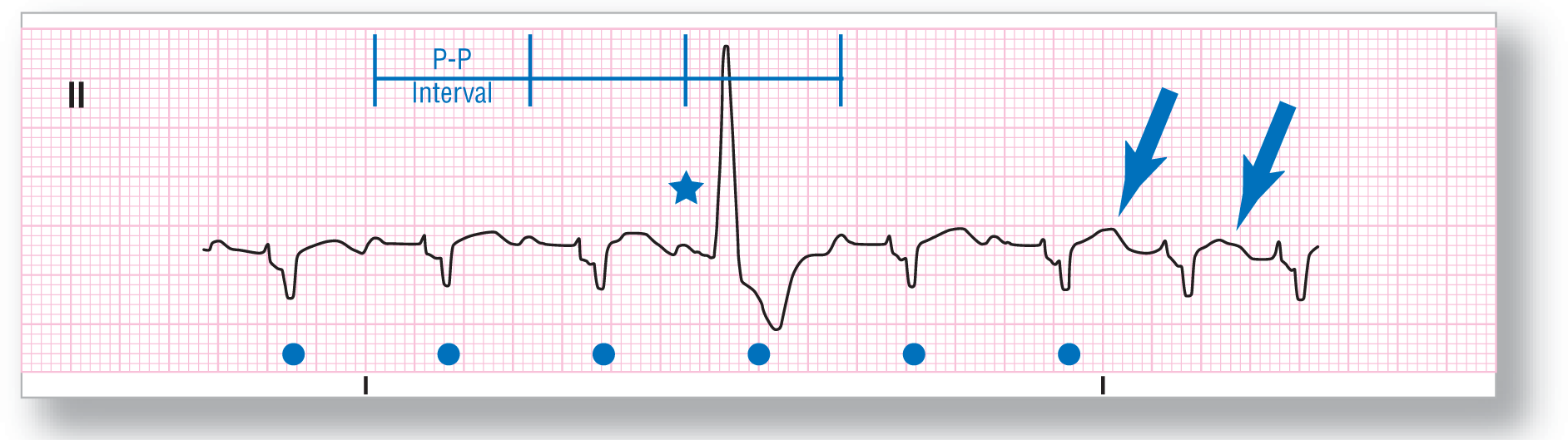 A rhythm strip from lead 2 illustrates sinus rhythm with a PVC.