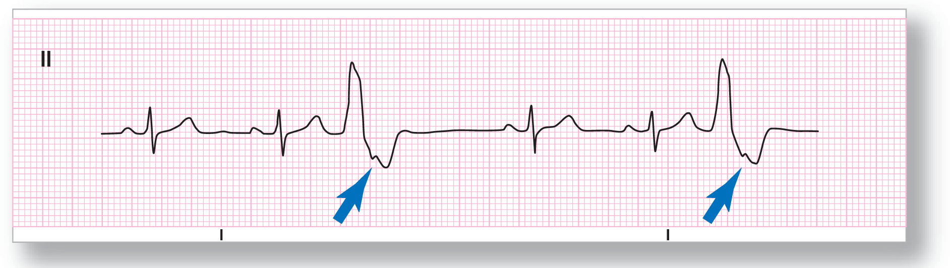 A rhythm strip from lead 2 illustrates sinus rhythm with ventricular trigeminy.