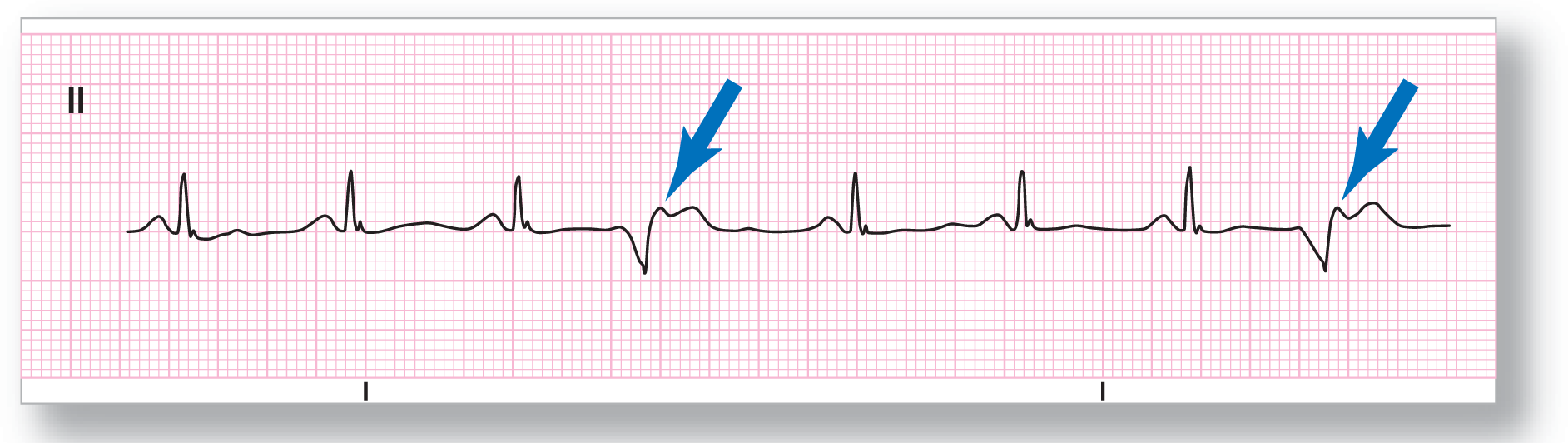 A rhythm strip from lead 2 illustrates sinus rhythm with ventricular quadrigeminy.