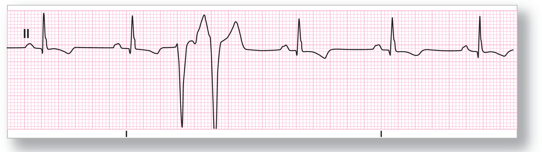 A rhythm strip from lead 2 illustrates sinus bradycardia with unifocal couplet.