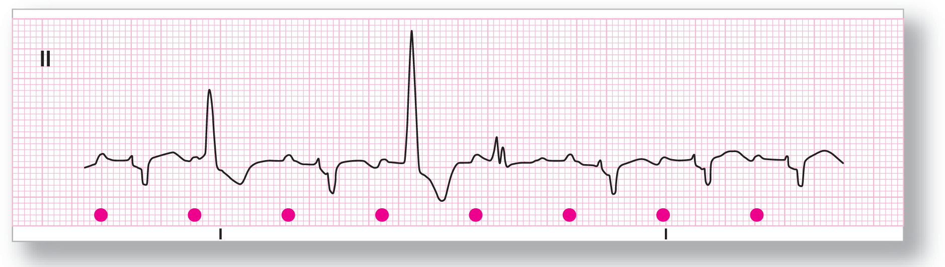 A rhythm strip from lead 2 illustrates sinus rhythm with multiple multifocal PVCs.