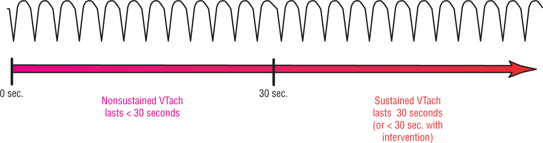 The ECG complex shows wide and curved peaks and sharp dips of high amplitude, occurring at high rate. Nonsustained VTach lasts less than 30 seconds, while sustained VTach lasts 30 seconds, or less than that with intervention.