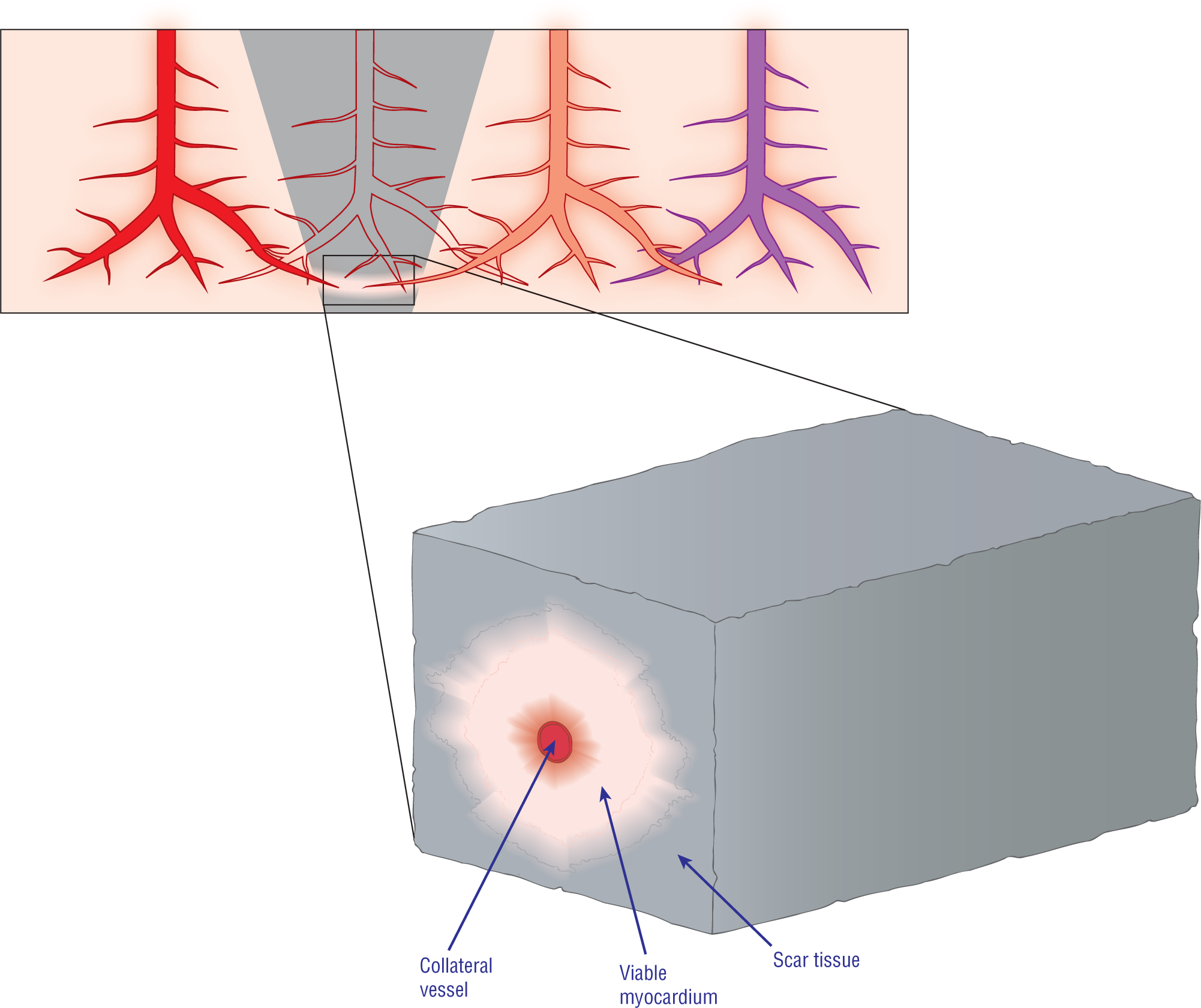 The illustration shows two blood vessels penetrating an infarcted area. A magnified view shows a collateral vessel surrounded by viable myocardium in a scar tissue.