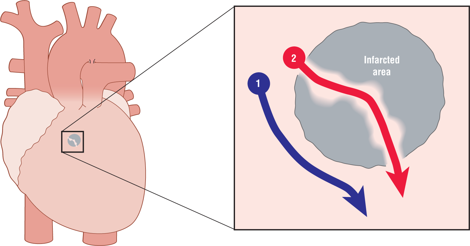 The illustration shows two pathways in the heart: a normal pathway of depolarization 1 around the infarcted area and an electrical pathway 2 through the island of infarcted area.