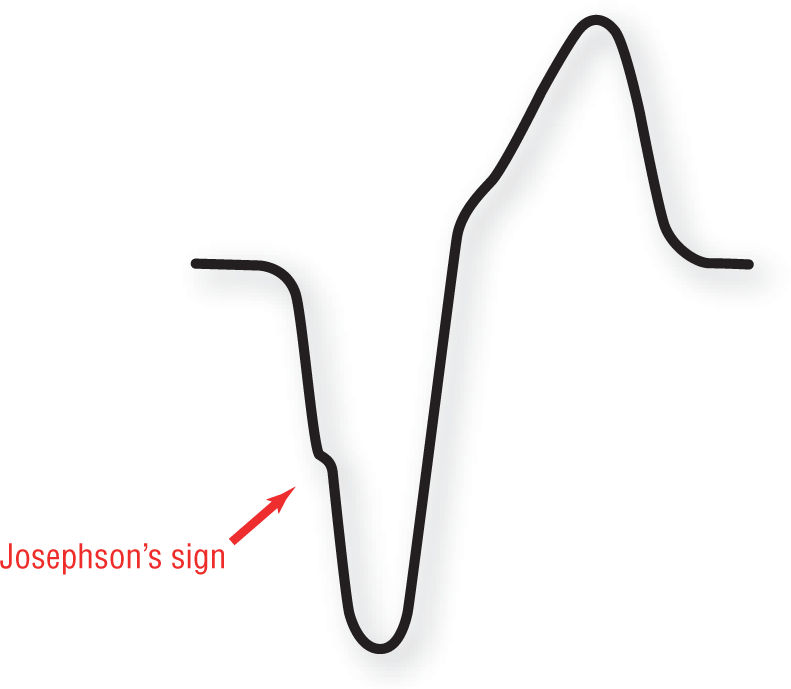 The illustration of an ECG complex shows that Josephson’s wave is the notch in the downstroke of the S wave.