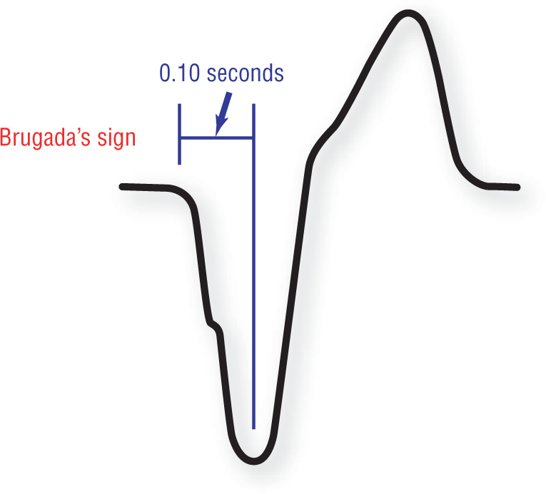 The illustration of an ECG complex shows that Brugada’s sign is the distance between the onset of the QRS complex and the bottom of the S wave. The distance is greater than or equal to 0.10 seconds.