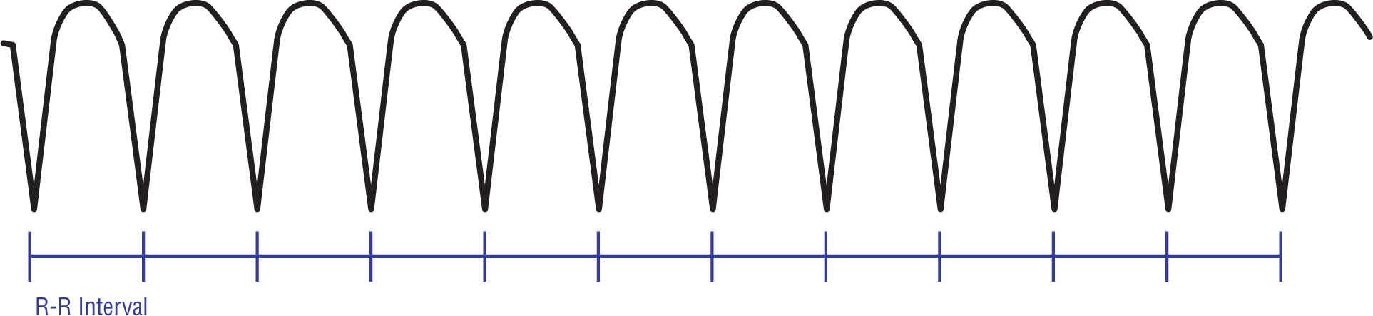 The ECG complex shows wide and curved peaks and sharp dips of high amplitude and high rate. The R-R intervals are constant.