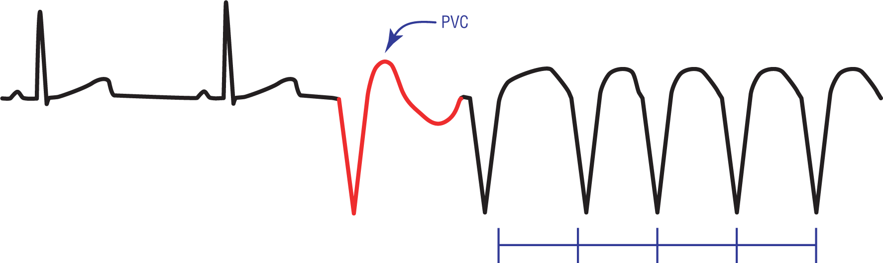 The ECG complex shows PVC occurring after normal complexes, which leads to ventricular tachycardia.