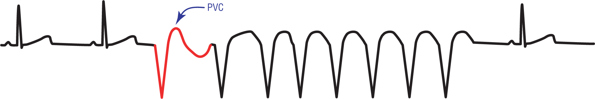 The ECG complex shows a PVC after normal complexes, leading to ventricular tachycardia and then to normal complexes.